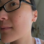 Morning_face_pimples